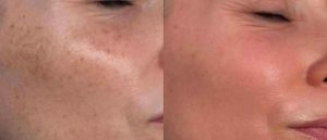 ipl skinimprovements